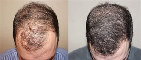 best mens hair restoration st louis|Neograft Hair Transplant Clinic .